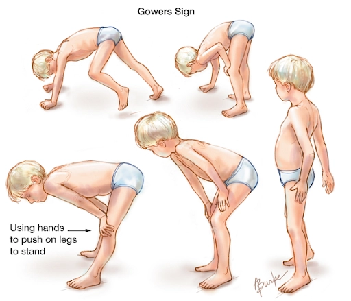 Vì sao bệnh loạn dưỡng cơ Duchenne xảy ra ở trẻ em?