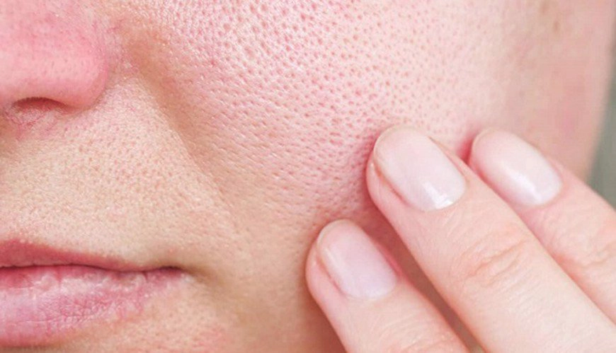 Vì sao khó trị dứt điểm mụn đầu đen và lỗ chân lông to?