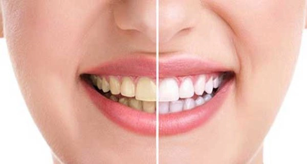 Vì sao răng bị đổi màu?