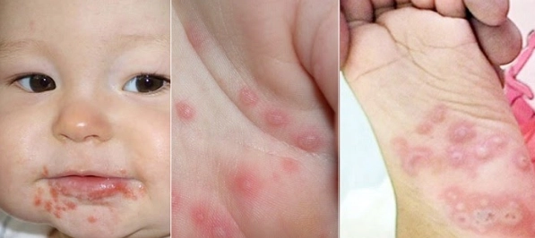 Vì sao tay chân miệng ở trẻ em lại nguy hiểm?