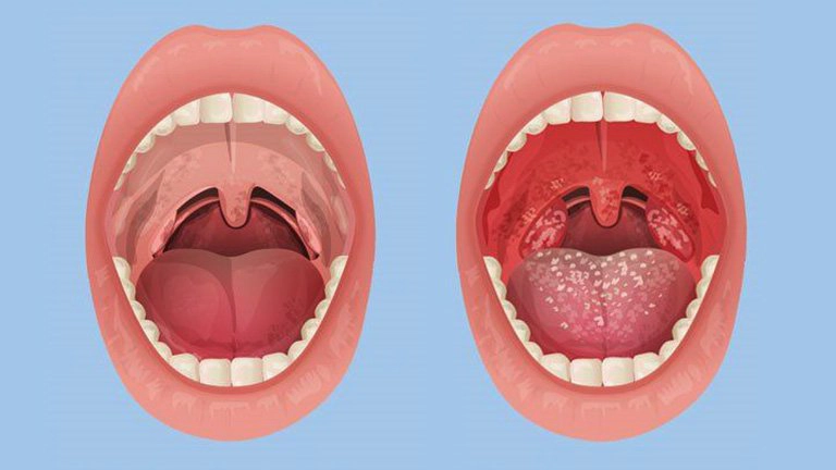 Viêm amidan kèm men gan cao điều trị thế nào?