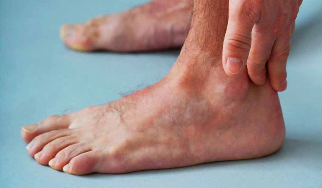 Viêm da do ứ đọng tĩnh mạch