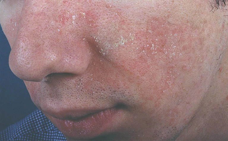 Viêm da tiết bã điều trị dứt điểm được không?