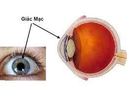 Viêm giác mạc dị ứng hay tái lại có điều trị dứt điểm không?