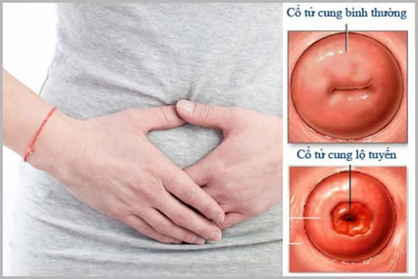 Viêm lộ tuyến cổ tử cung độ 2 có nên đốt không?
