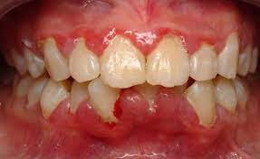 Viêm lợi trùm điều trị được không?