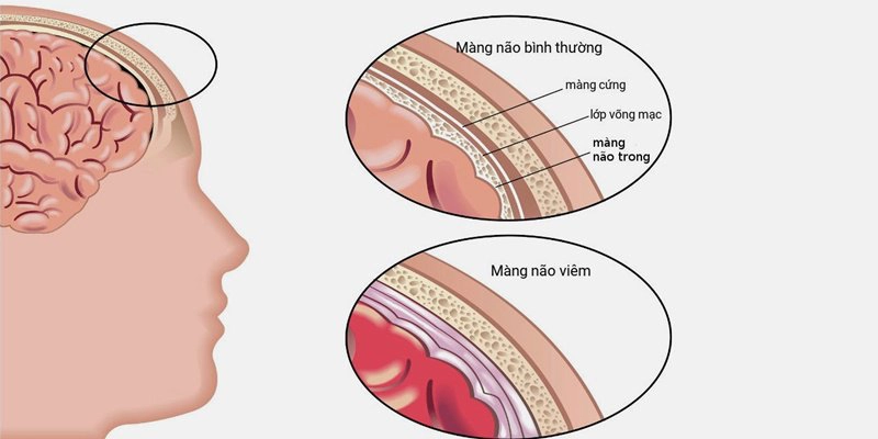 Viêm màng não có nguy hiểm không?