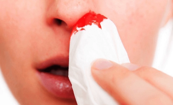 Viêm mũi dị ứng gây chảy máu mũi có sao không?