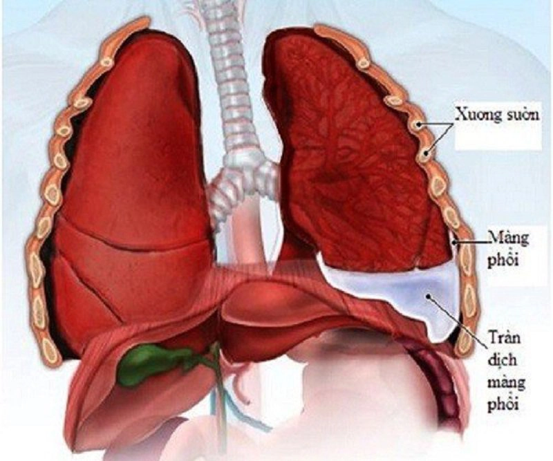 Viêm phổi cấp có thể tự khỏi không?