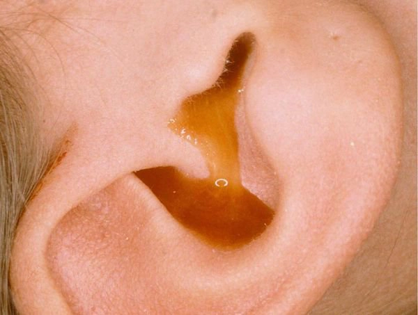 Viêm tai giữa điều trị như thế nào?