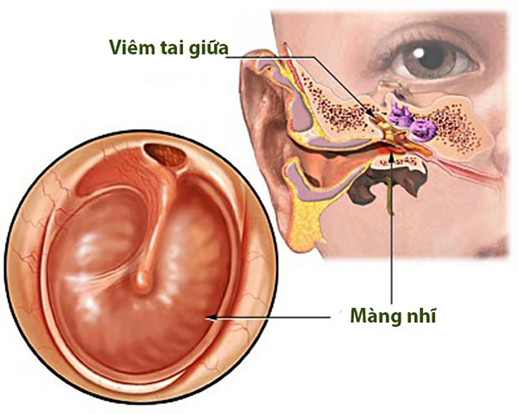 Viêm tai giữa mãn tính do thủng màng nhĩ
