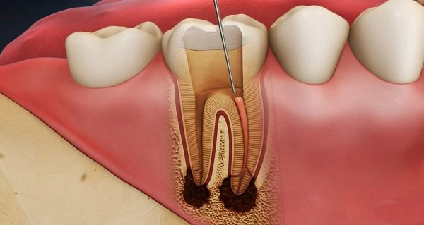 Viêm tủy răng bên trong phải điều trị thế nào?