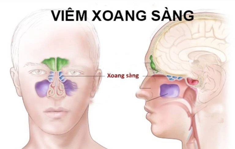 Viêm xoang sàng: Những điều cần biết