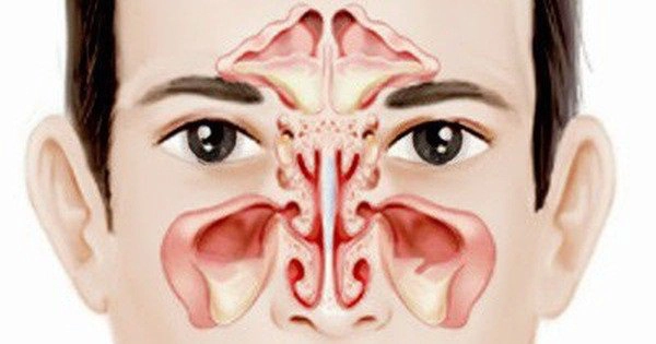 Viêm xoang trán lan ra viêm xoang hàm điều trị thế nào?