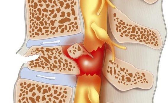 Vinmec có kỹ thuật nào chẩn đoán u tủy không?