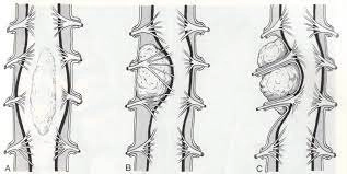 Vinmec thực hiện kỹ thuật nào chẩn đoán u màng ống nội tủy?