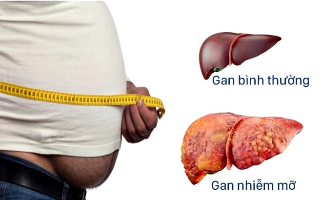 Xác định bệnh gan nhiễm mỡ không do rượu có nguy cơ tiến triển bệnh thận mãn tính