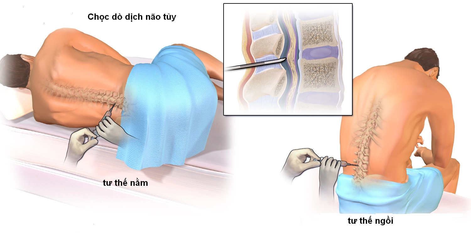 Xét nghiệm dịch não tủy (CSF)