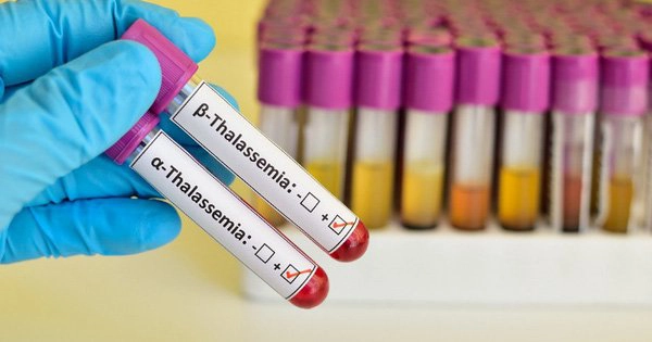 Xét nghiệm gì để biết bệnh Thalassemia?