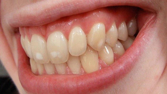 Xử lý đốm trắng trên răng thế nào?