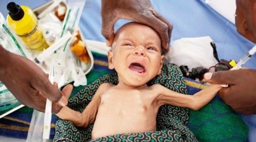 Xử trí cấp cứu ở trẻ suy dinh dưỡng nặng