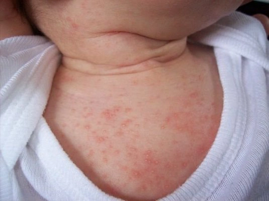 Xử trí khi trẻ bị rôm sảy ở cổ