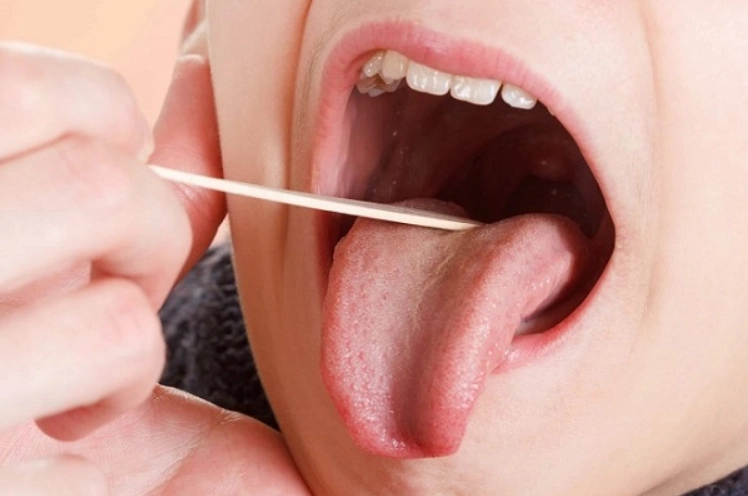 Xuất hiện đốm trắng ở hốc amidan sau cắt amidan có sao không?