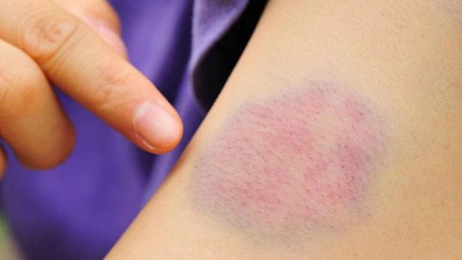 Xuất hiện vết bầm tím dưới da lâu ngày không khỏi có sao không?
