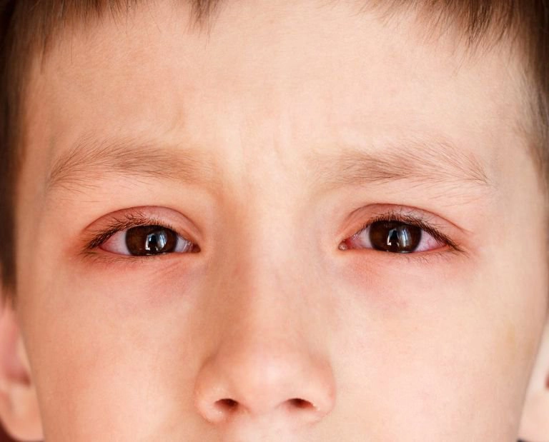 Xuất huyết dưới da quanh mắt có nguy hiểm?