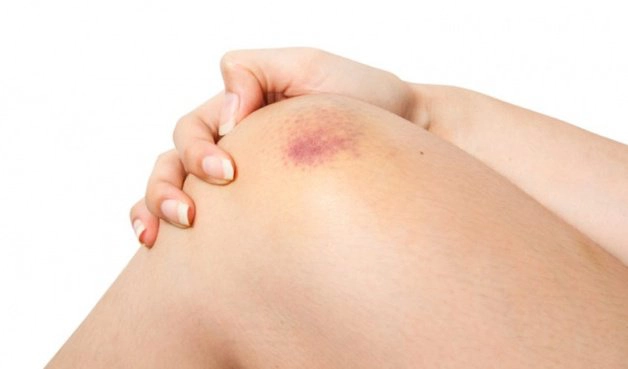 Xuất huyết dưới da: Vì sao không nên xem nhẹ?