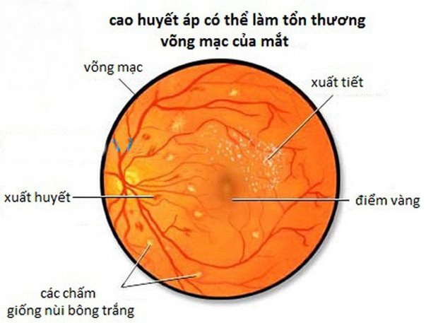 Xuất huyết võng mạc có để lại sẹo không?