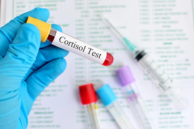 Ý nghĩa của xét nghiệm Cortisol